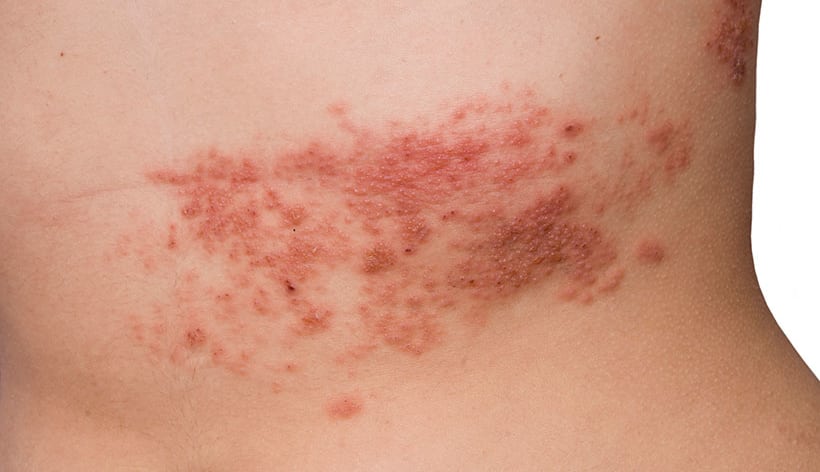Can You Still Get Shingles After Having The Chicken Pox Vaccine Vaxopedia