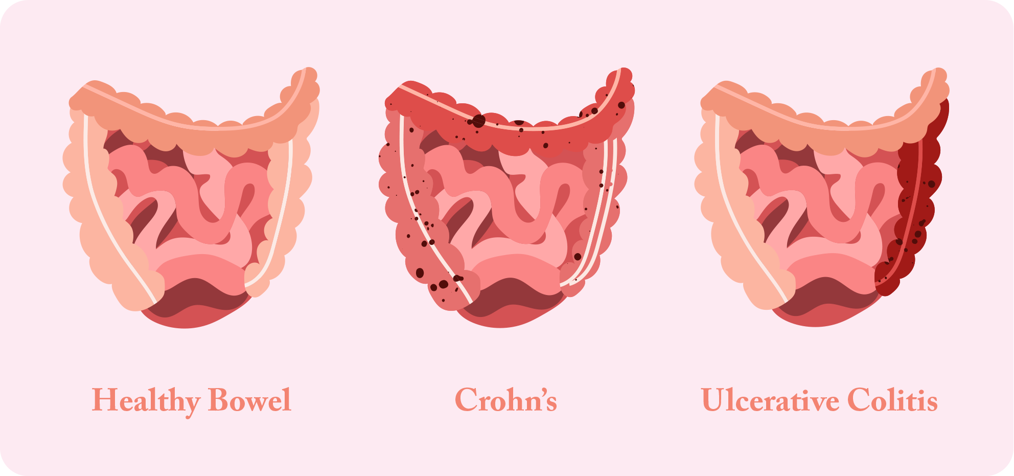 Crohn's Infographic