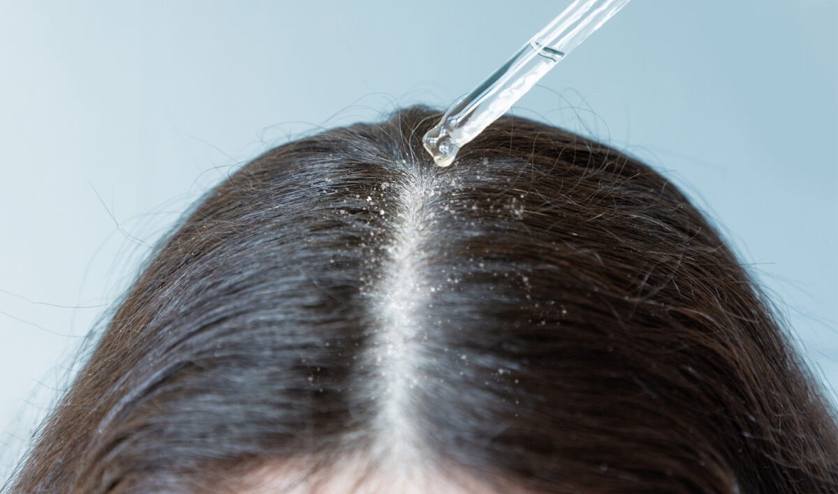 Scalp conditions | Family Health Diary